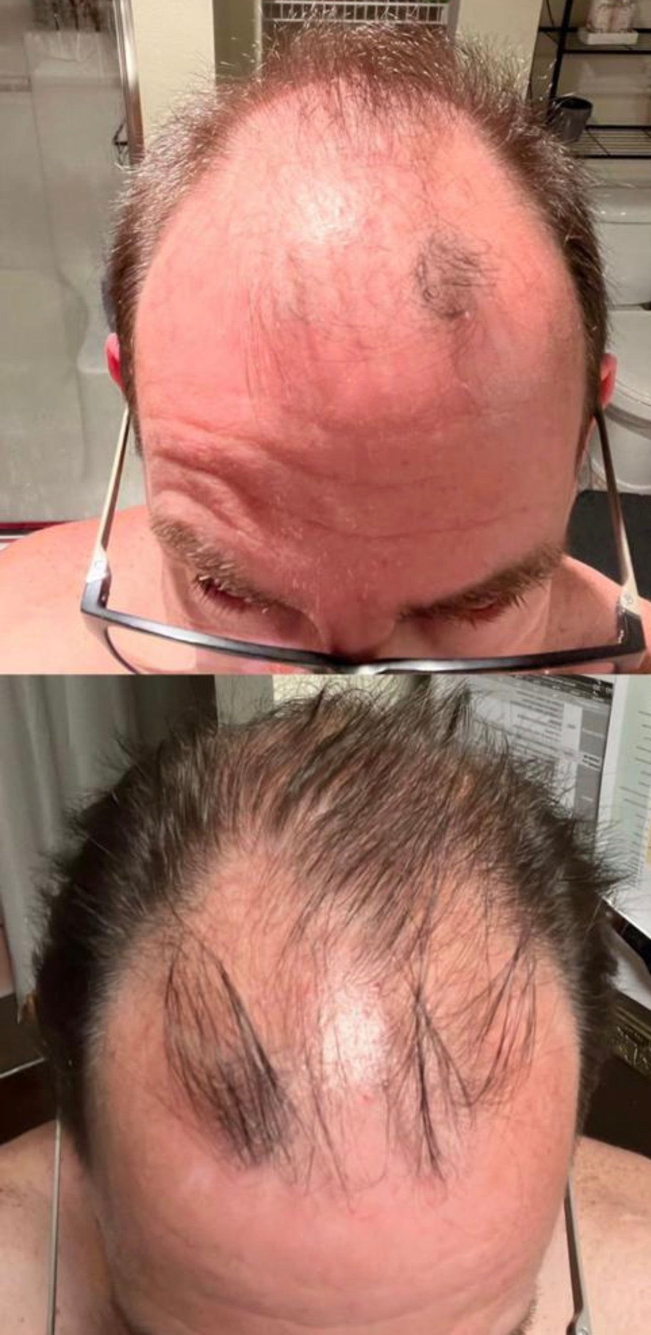 Mirra Capsitrat Anti-hair Loss Treatment Kit